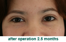 plastic-surgery-blepharoplasty